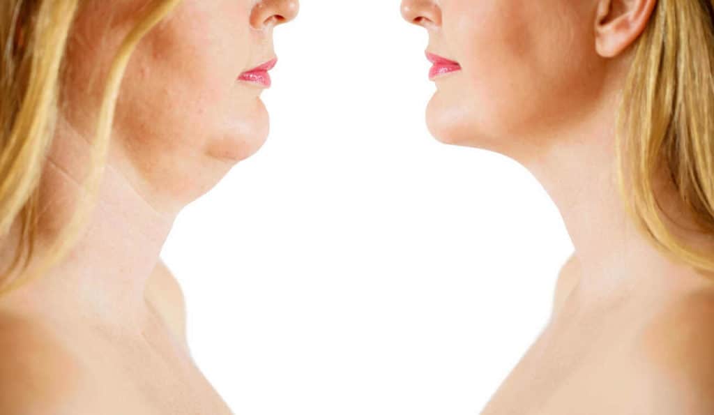 Double Chin treatment West Sussex before and after results