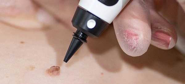After Skin Tag Removal West Sussex