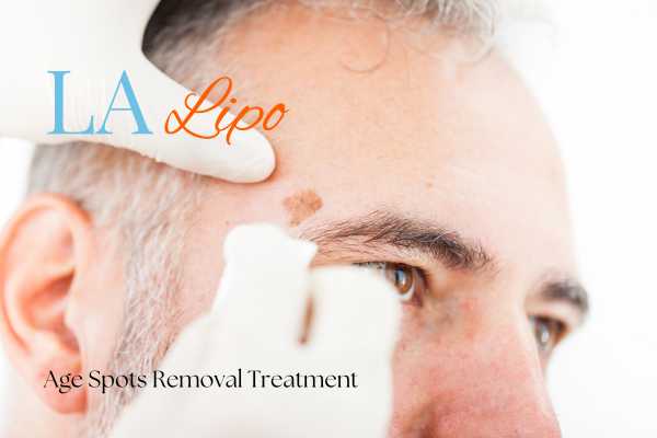 What Are the Most Effective Treatments for Age Spots West Sussex?