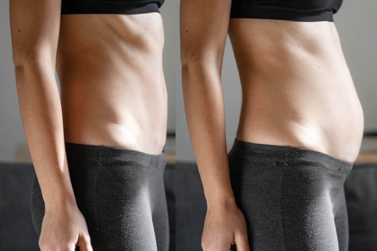 How long does diastasis recti take to improve West Sussex?