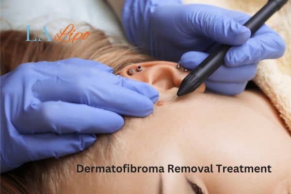 Dermatofibroma Removal Treatment West Sussex