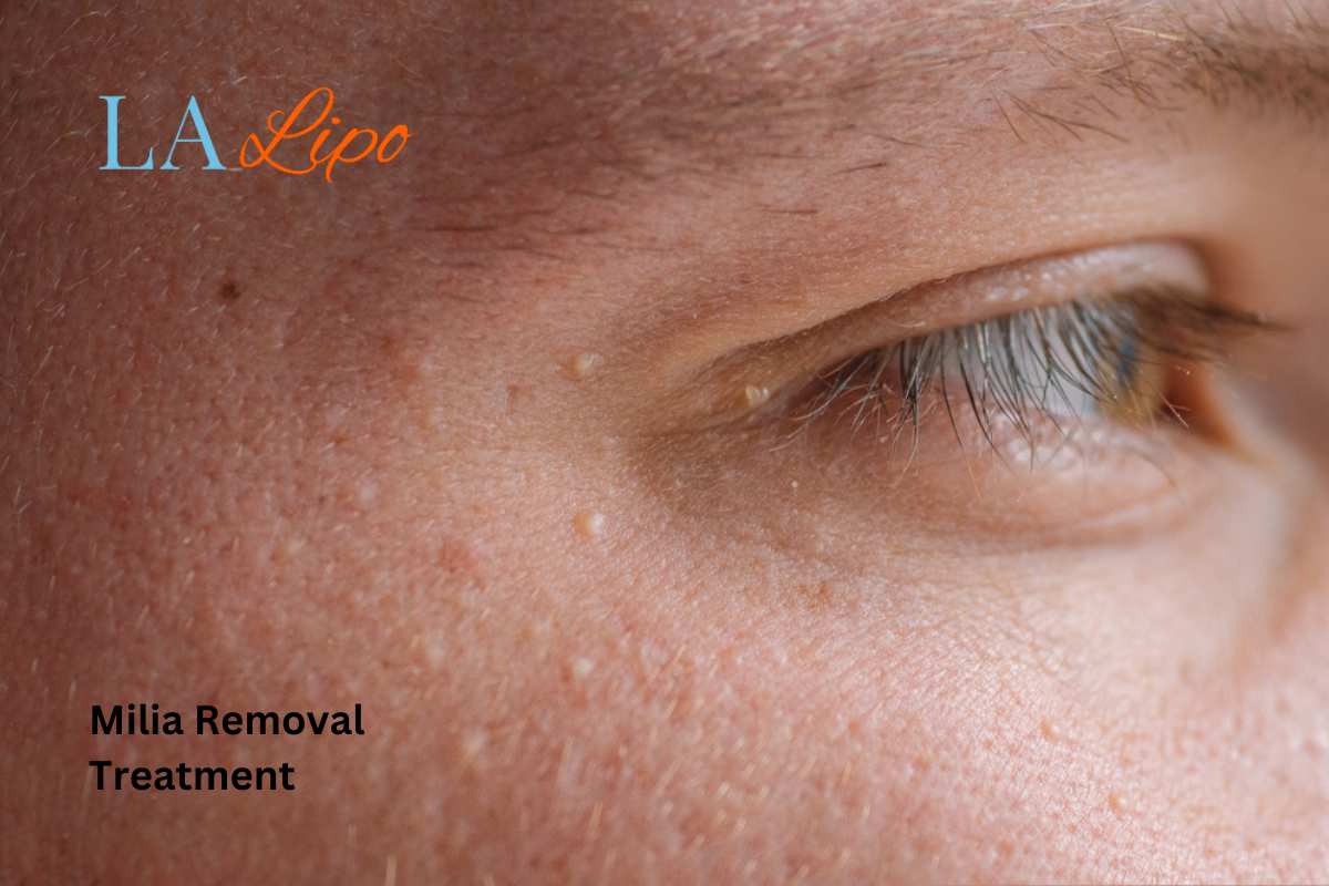 Cryopen Milia Removal: Is It the Easiest and Safest Option West Sussex?