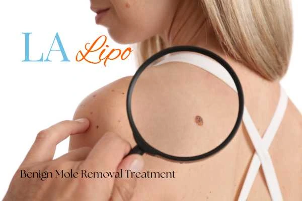 Why getting moles removed West Sussex can boost your confidence!
