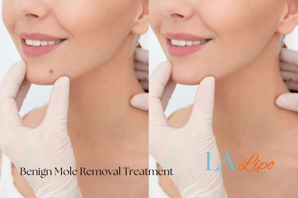 Woman's before and after results of being moles removal treatment West Sussex