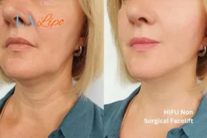 hi-fu for wrinkles West Sussex before and after results