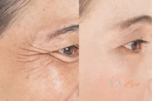 Before and after results of woman - HI-fu wrinkles reduction treatment West Sussex