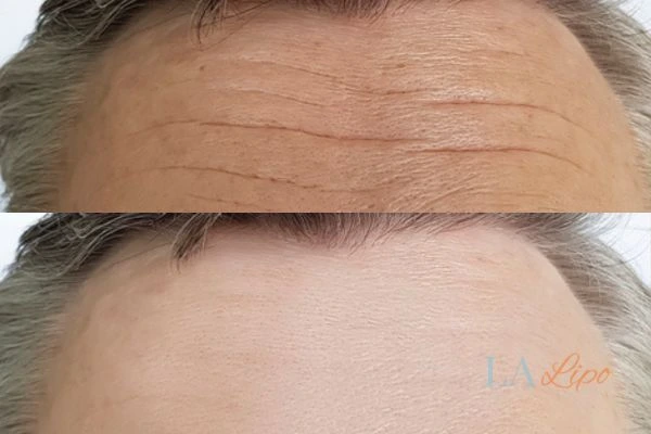 results of HIFU West Sussex on mans forehead to help reduce lines and wrinkles