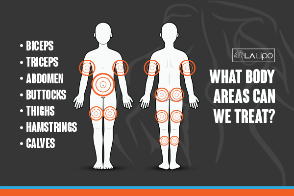 Graphic to show areas you can have LA-EMS Body Sculpting West Sussex treatment.