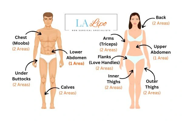 LA LIPO Cryolipolysis Areas West Sussex