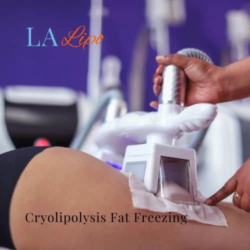 fat freezing - Cryolipolysis West Sussex