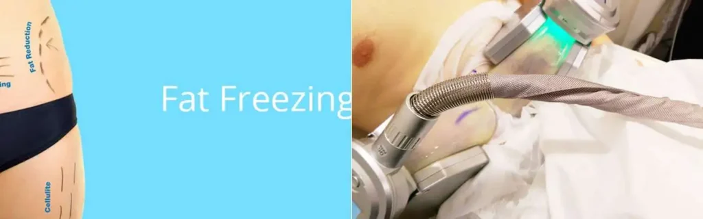 multi areas of a persons body having coolsculpting West Sussex treatment