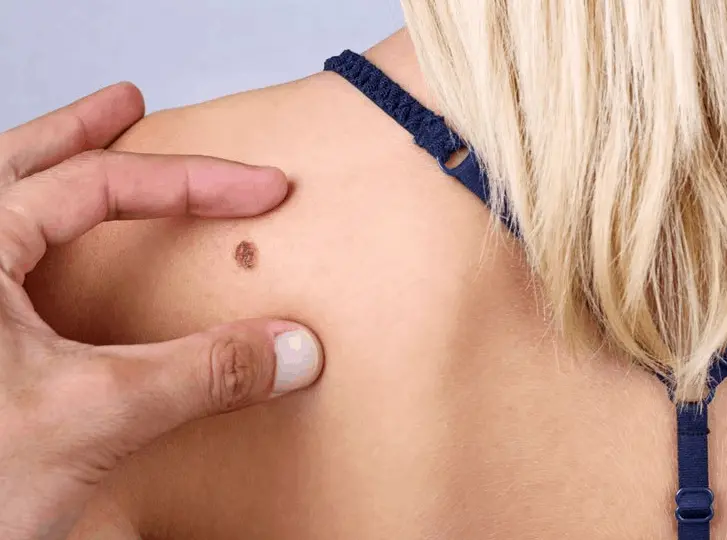 woman having mole removal West Sussex consultation before treatment.
