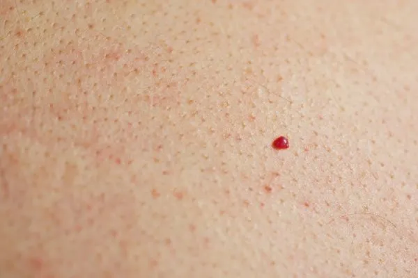 close up of a cherry angioma West Sussex