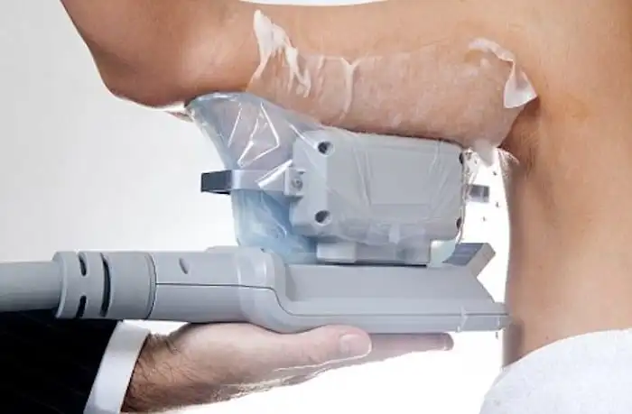 Picture of fat freezing West Sussex on the upper arms.