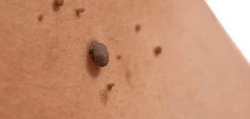 image of a skin tag West Sussex