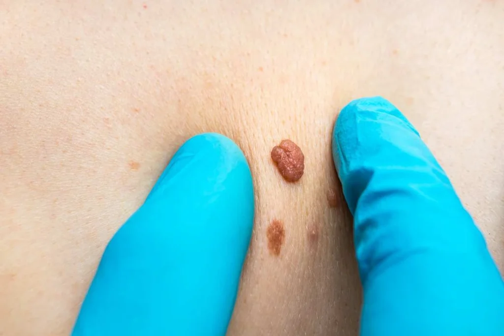 Consultant examining a skin tag West Sussex