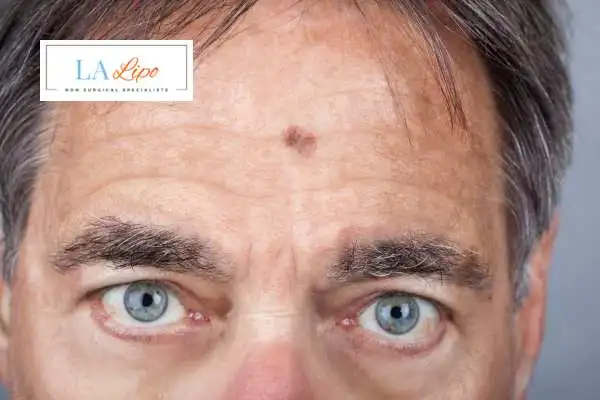 Solar Lentigo Removal West Sussex image of man with mark on his forehead