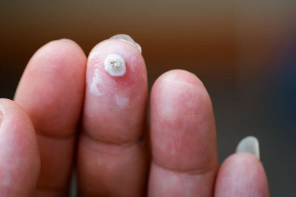 wart on person finger - cryotherapy to treat from LA LIPO West Sussex