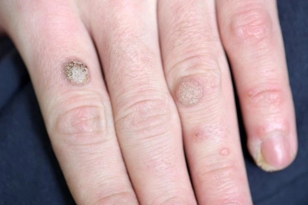 photo of warts on person hand - see wart removal West Sussex from LA LIPO