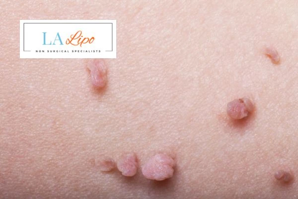 Does cryopen skin tag removal West Sussex hurt? Find out now call our team today!