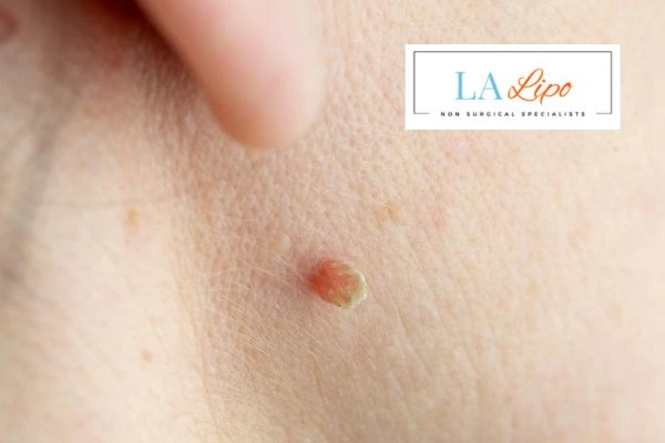 Book skin tag removal West Sussex today speak to our team now!