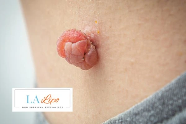 Interested in skin tag removal West Sussex? Concerned about the pain? Find out more today!