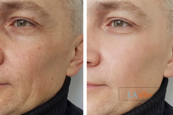 See the amazing results of Morpheus8 Treatment West Sussex!