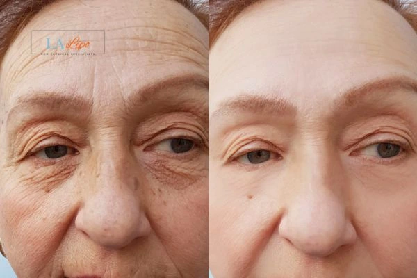 The powerful benefits of Morpheus8 Treatment West Sussex - Call Our team today!