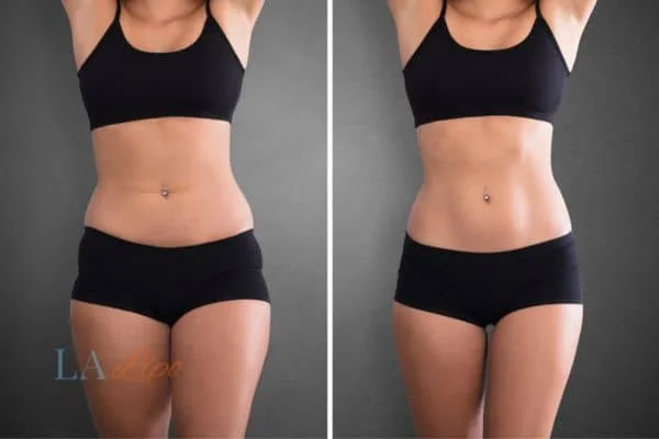 before and after results of non-surgical treatment to help a woman's body image and mental health West Sussex