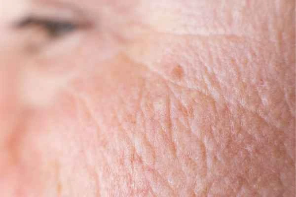 close up picture of a woman's face showing an age spot West Sussex