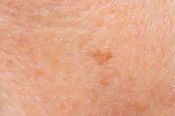 close up picture of age spots West Sussex