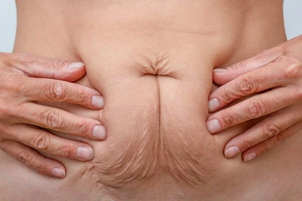 Image of a woman's stomach with loose skin - example of skin tightening West Sussex options