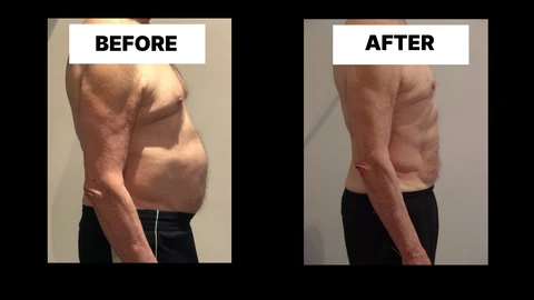 What Symptoms Can Diastasis Recti Cause in Men? Weak Core, Back Pain and Poor Posture West Sussex